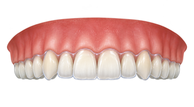 Clear retainers illustration